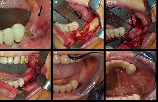 View of mandibular alveolar process in patient 2: (A) preoperative BRONJ affected area; (B) curetted area; (C) HAM application; (D) suture of mucosal soft tissues; (E) and (F) postoperative follow-up after a period of 180 days.
