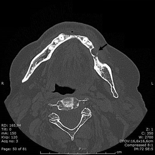 Preoperative occlusal X-ray of mandible of patient 2.