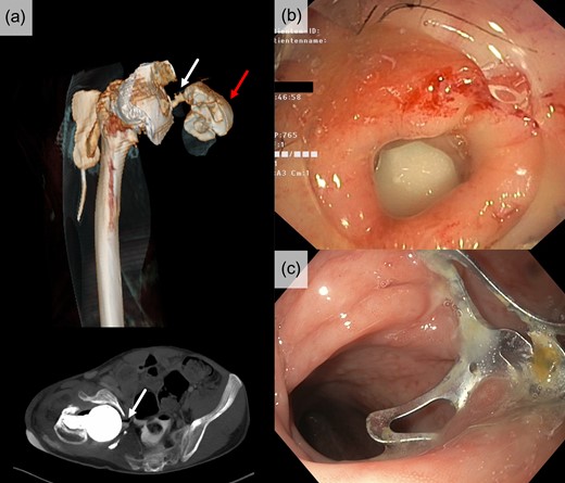 (a) CT-scan including a 3D-reconstruction (upper image) with rectal contrast media (red arrow) revealed a recto-acetabular fistula (white arrows). (b) Endoscopic view on the fistula prior over-the-scope clipping (OTSC®). (c) Successfully closed fistula with a 14/6 t OTSC® clip in situ.