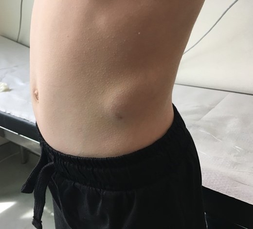 Photograph of the 6-year-old boy at the time of admission, showing the swelling above the left iliac crest.