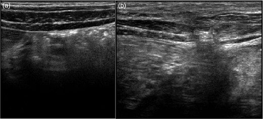 Ultrasound images of the right (a) and left (b) side of the abdominal wall at the time of admission. Left side: disruption of internal and external oblique and transverse muscles and projection of omentum.