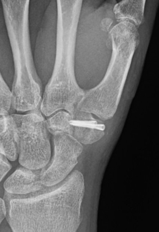 Post-operative plain radiograph.