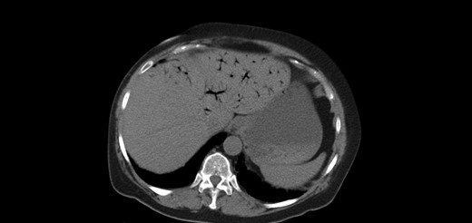 Extensive portal venous gas noted in the left lobe of the liver during the first admission. Laparotomy was negative for bowel ischemia.