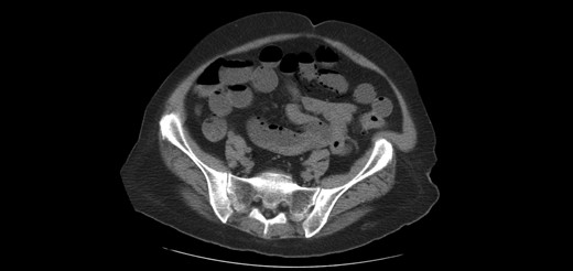 Pneumatosis of the small bowel during the first admission.