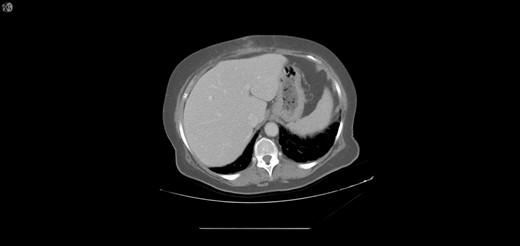 Normal appearing liver during the second admission.