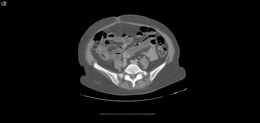 Extensive pneumatosis of the small bowel during the second admission. Approximately 5 feet of ischemic bowel resected.