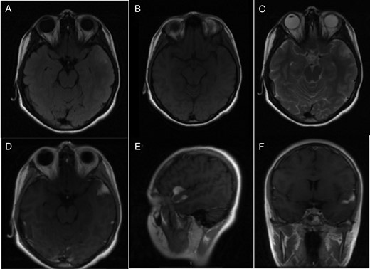 (A) T2 flair sequence showing a slightly hyperintense lesion. (B) Lesion behaves isointense to brain parenchyma in T1 sequence. (C) Hyperintense in T2 sequence. (D–F) Axial, sagittal and coronal images, respectively, with contrast enhancement of the tumor.