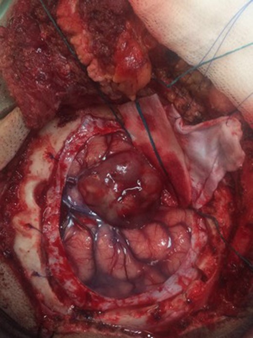 Macroscopic image of the tumor. Exophytic growth can be seen with the involvement of the arachnoid plane at the level of the Sylvian fissure.