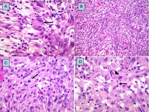 Histopathology. Fibrillar matrix with pleomorphic cells, some with gemistocytic appearance (arrow) (A), alternating with areas of spindle cells arranged in interlaced fascicles (B), and round cells with epithelioid appearance (C), with mitosis figures (arrows), as well as others with nuclear atypia and pseudointranuclear inclusions (arrowhead) (D). Hematoxylin and eosin staining, ×40.