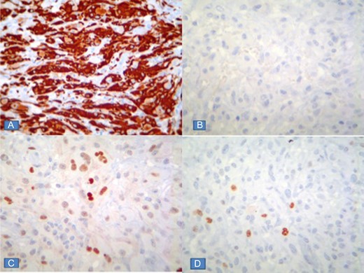 Immunohistochemical reactions showing intense positivity for gliofibrillary acid (A) protein, negativity for epithelial membrane antigen (B), p53 positivity in 30% of neoplastic cells (C), and Ki67 proliferation index of 5% (D).