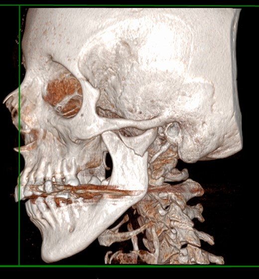 CT scan shows left mandibular subcondylar fracture.