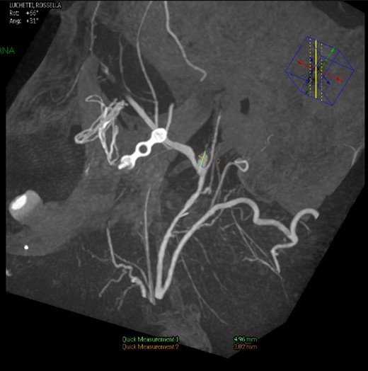 Left common carotid artery angiography in lateral views shows the PA (4.9 × 3 mm).