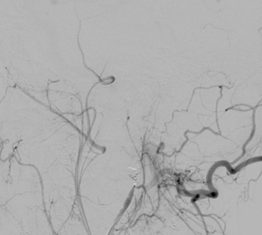 The post-embolization angiogram.