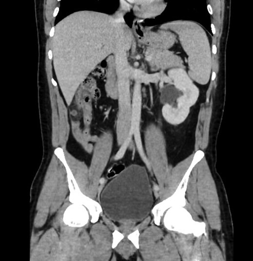 Sagittal view showing mal-descend of caecum secondary of congenital agenesis of right kidney, this resulted in subhepatic appendicitis.