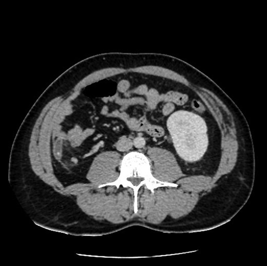 Axial view showing absence of right kidney due to congenital agenesis. Appendicitis with faecolith.