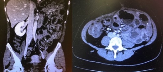 Distended small-bowel loops located mainly in the left hemiabdomen.