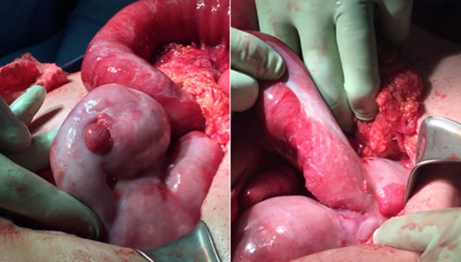 Whitish thick envelope of fibrocollagenous tissue encapsulating most of the small-bowel.