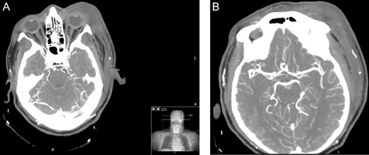 Axial CT angiogram carotids images showing (A) diffuse left periorbital region involvement with no retro-orbital or extra-orbital collections. (B) No evidence of vessel thrombosis.