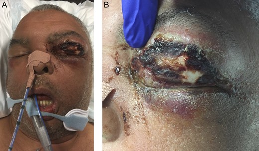 (A) An image of the patient post-intubation demonstrating marked left periorbital oedema and violaceous erythematous and necrotic changes. (B) A close-up of the left periorbital region skin changes.