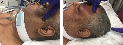 Lateral views demonstrating extension of the swelling over the lateral aspect of the face (A) and scalp (B). Purulent material can be seen weeping from the tissue.
