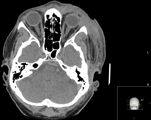 Axial CT Orbits performed on Day 7 post-debridement, showing improved left periorbital soft tissue swelling. No post-septal involvement, orbit breach or identifiable collections.