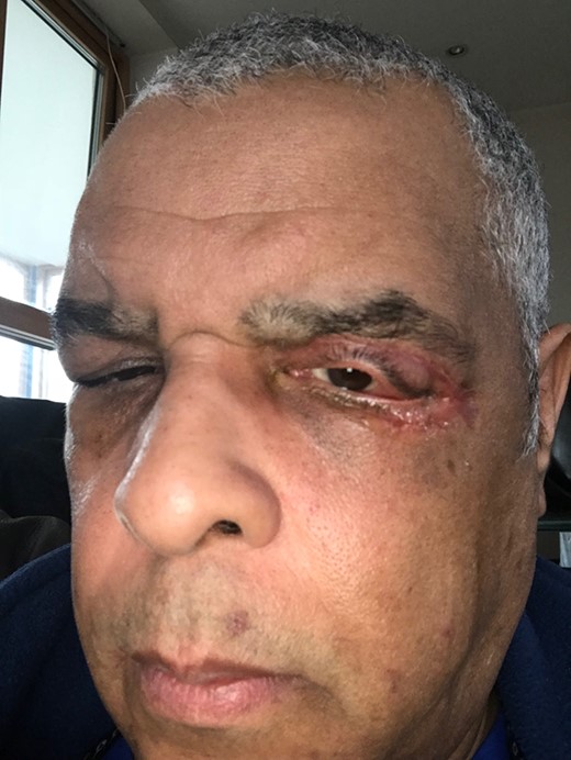 An image 3 months post-surgery showing good wound healing and a residual ectropion on the left upper eyelid.