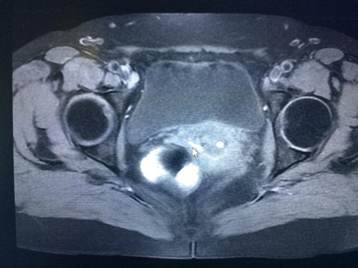 MRI illustrating the fistulous tract.