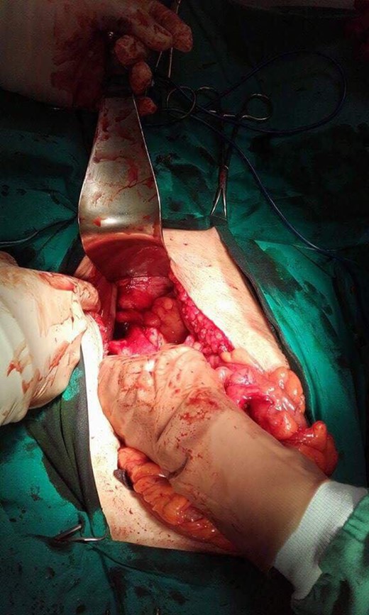 Fistula between the rectosigmoid and the vagina.