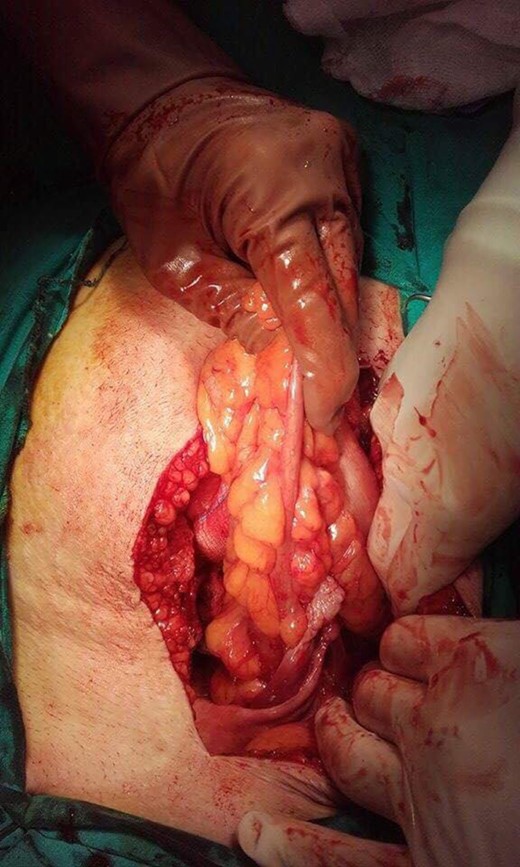 Fistula between the sigmoid and the left ovary.