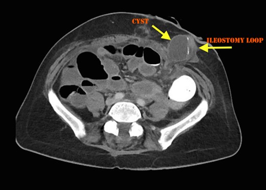 Cross sectional CT Image showing compression of ileostomy opening.