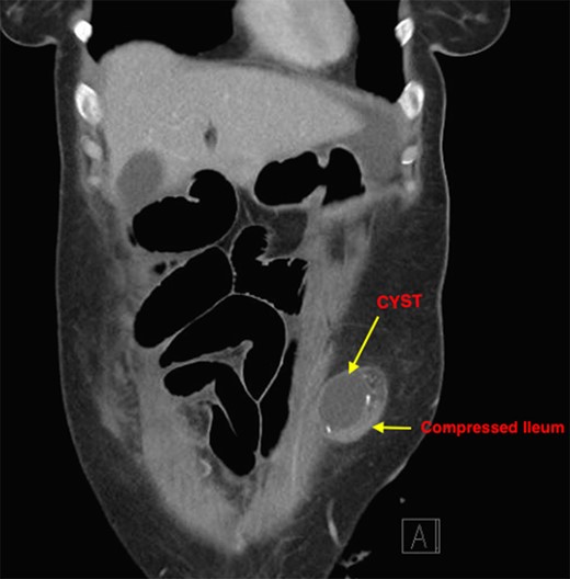 Coronal section showing compression of ileostomy.