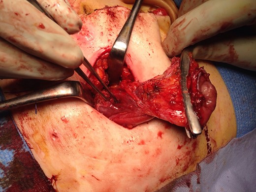 Cystic mass opened confirming remnant of efferent loop.