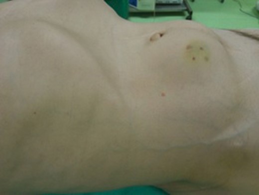The patient presented with a 11 × 10 cm soft and well defined, palpable mass on the right side of the abdominal wall.