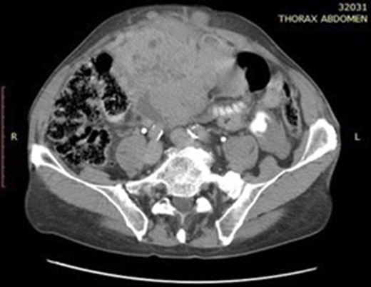 Abdominal CT scan showing a inhomogeneous hypervascular mass.