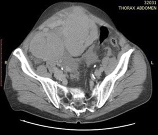 Abdominal CT scan showing two hypervascular lesions in the abdomen.