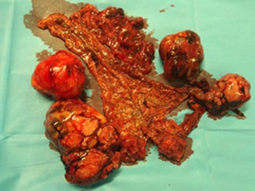 Intra-operatively three lesions derived from the greater omentum were excised along with the greater omentum.