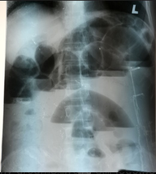 Erect abdominal X-ray showing multiple air fluid level with dilated small bowel loops.