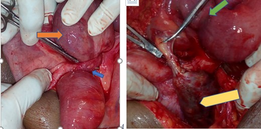 Appendix with mucocele entangling distal ilium forming closed loop obstruction (blue arrow—appendicular knot, orange—entangled distal ilium, green—the pressure mark on the distal ilium and yellow—gangrenous appendicular mucocele).