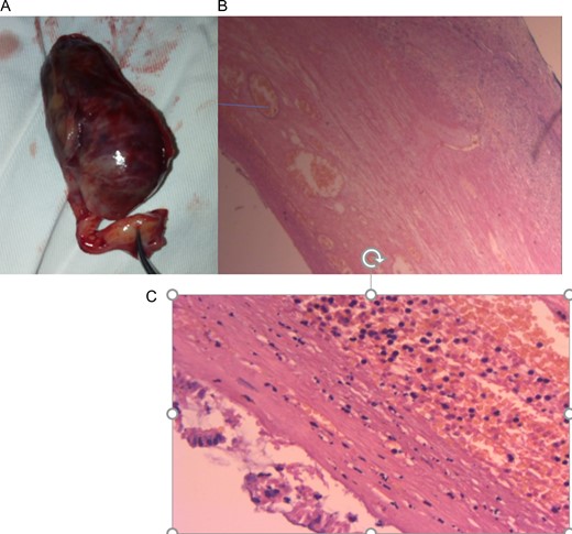(A) Post-appendectomy gangrenous appendix with mucocele, (B) and (C). Histologic specimen per low power and high power field microscopy showing appendicular mucocele with some haemorrhagic infracts with thinned out mucosa and no extension beyond the submucosa.