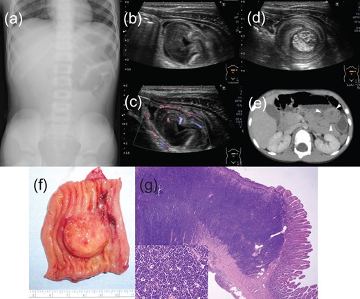 (a) Supine abdominal radiograph at initial presentation demonstrates a bowel gas pattern with gaseous distension of the left-upper small bowel loops. (b) Focused sonography of the abdomen demonstrates a well-circumscribed area of low echogenicity in the lumen of the intestine, (c) and power Doppler sonography detected abundant blood flow signals in that area. The lesion was ~20 × 5 mm2 in size. (d) A ‘target pattern’ was observed in the adjacent intestinal loops, which suggested intussusception. (e) CT scanning confirmed an intestinal intraluminal mass in the left-upper quadrant (white arrowhead). (f) Freshly exophytic tumor bulging into the jejunal lumen, involving half the circumference of the wall. (g) The tumor is composed of scattered pale tiny body macrophages on a dense background of monomorphic, intermediate-sized lymphocytes, creating a ‘starry sky’ pattern (lower left).