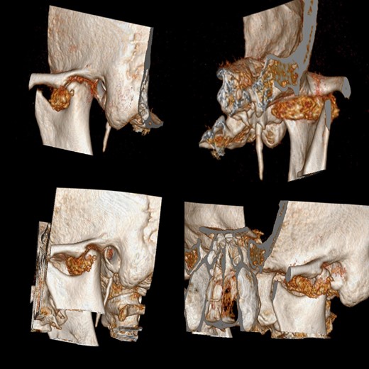 CT scan before surgery shows an oval-shaped formation of 3.5 cm diameter located in the left temporomandibular joint.