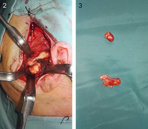 How tumor looks like intraoperatively. It was located right inside the articular capsule.