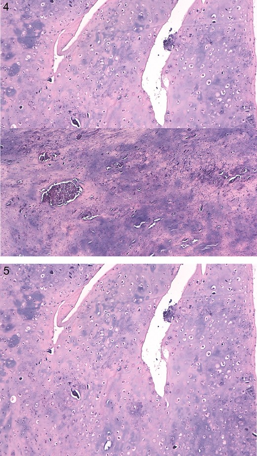 Definitive histological report showing grungy calcification and multinucleated giant cells positive for S100 proteins and AE1/AE3 negative.