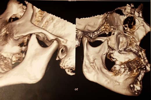 CT scan after surgery.