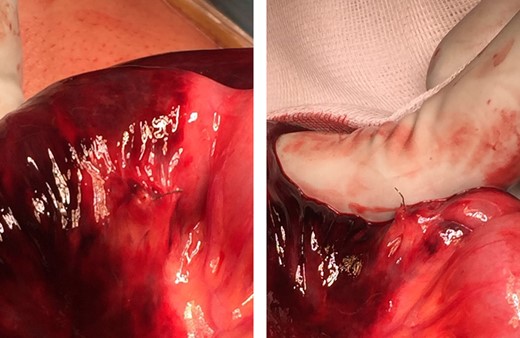 Impacted surgical clip on the mesenterial side of the small bowel wall.