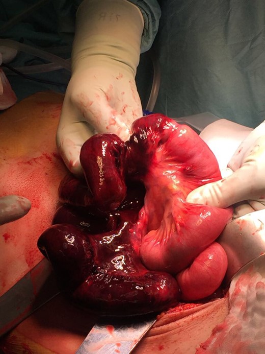 Volvulus with bowel necrosis.