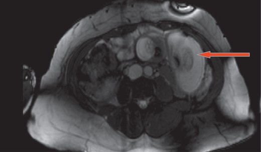 Magnetic resonance imaging shows intussusception of small bowel with close loop obstruction (cross section).