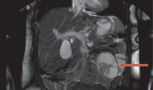 Magnetic resonance imaging shows intussusception of small bowel with close loop obstruction (coronal view).