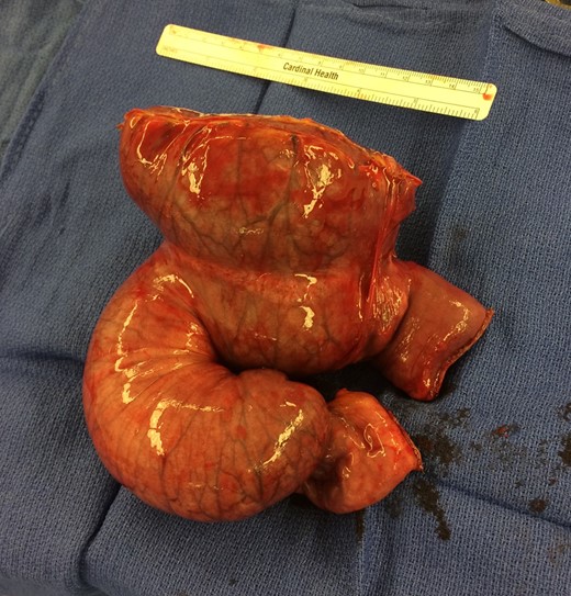 Gross specimen showing resected; irreducible intussusceptions.