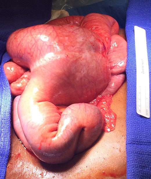 Gross image showing irreducible intussusception at the jejuno-jejunostomy.
